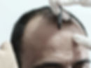 Restoring the frontal frame with soft, single-hair grafts for an undetectable hair transplant result.