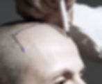 A clinical and architectural explanation of male pattern baldness and genetic hair loss at Eva Estetica Istanbul.