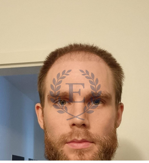natural hair transplant before and after with refined hairline