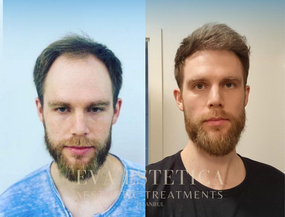 Hair Transplant Eva Estetica ist