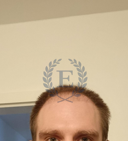 Hair transplant before after