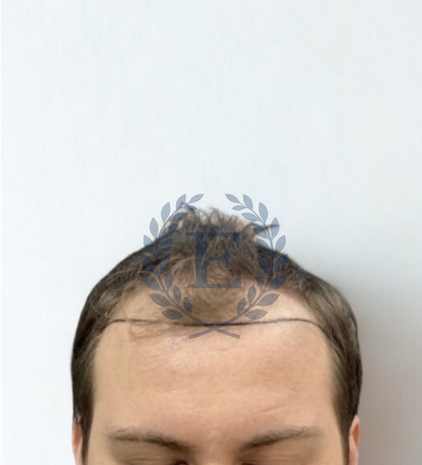 Hair transplant before after at eva estetica istanbul