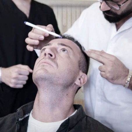 Bespoke hair restoration planning at Eva Estetica Istanbul focusing on facial geometry and architectural design.
