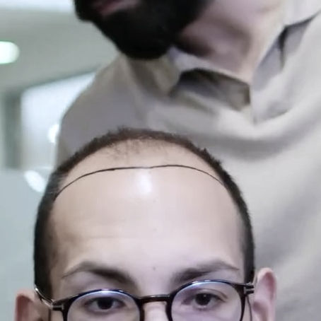 A clinical expert at Eva Estetica performing a high-definition scalp audit to diagnose the exact biological differences between diffuse thinning vs receding hairline.