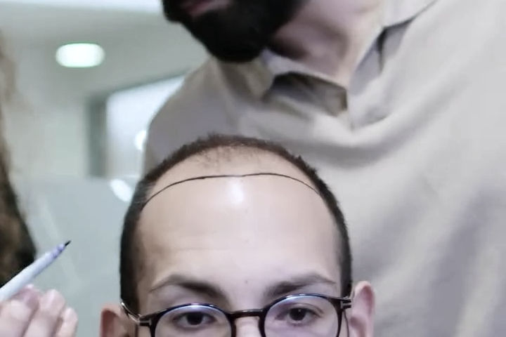 A clinical expert at Eva Estetica performing a high-definition scalp audit to diagnose the exact biological differences between diffuse thinning vs receding hairline.