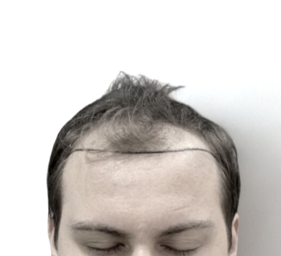 Planning phase in an Istanbul clinic, focusing on the soft, staggered pattern required for an undetectable hairline drawing.