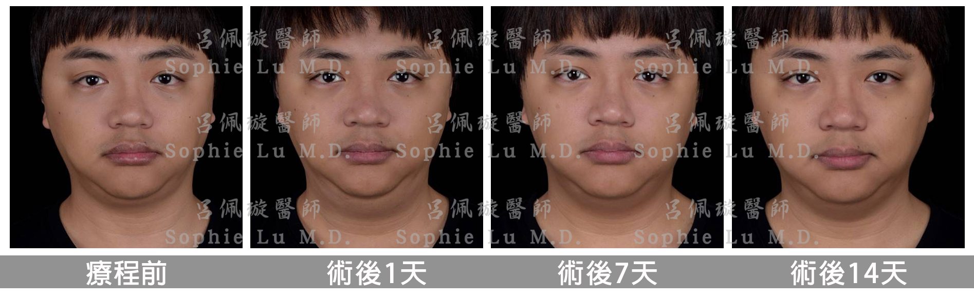 倍克脂belkyra 美國消脂針完整問答集呂佩璇醫師