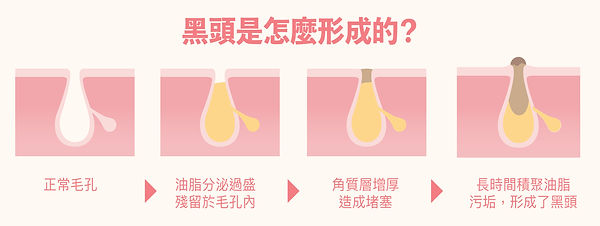 黑頭是怎麼形成的