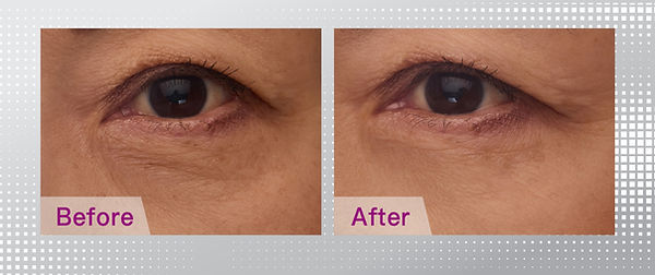 中年人士眼周鬆弛及魚尾紋特寫照片,展示未做 Thermage 眼部療程前常見的眼紋及眼袋問題