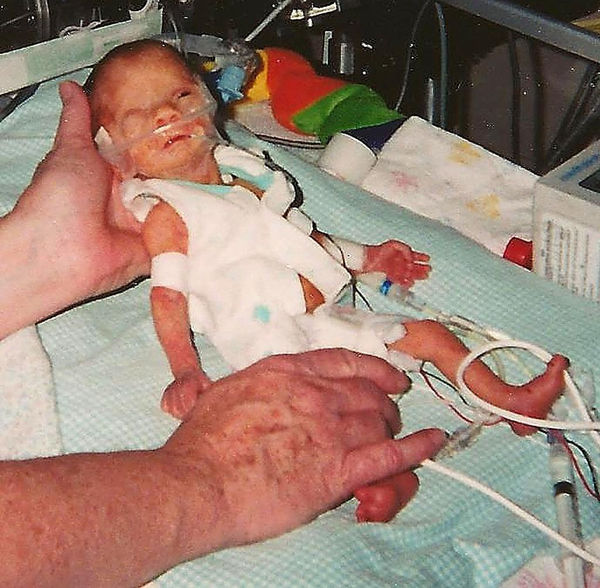 Premature NewBorn