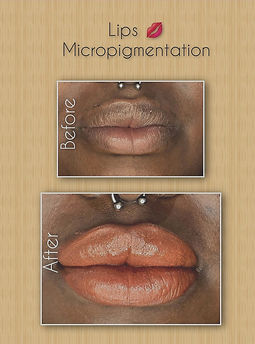 Lip micropigmentation