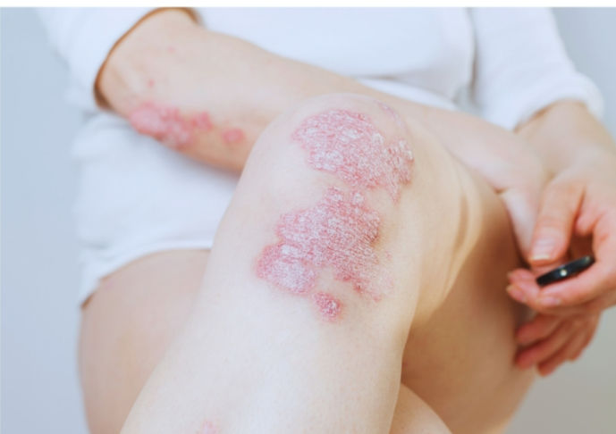 Psoriasis on knees and elbows