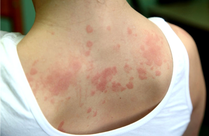 Eczema on someone's back