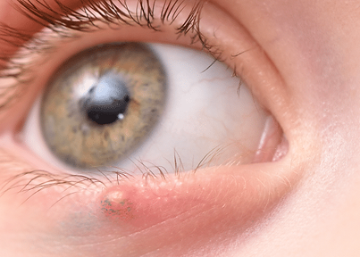 CIRURGIA DE TUMORES PALPEBRAIS.png