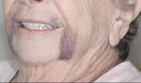 pós-operatório implante dentário