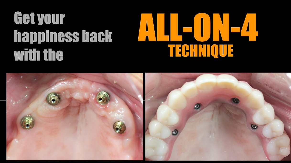 Full Mouth Implants.jpeg