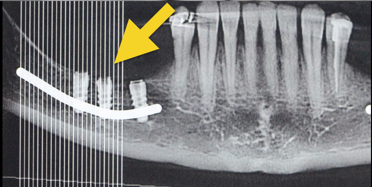 radiografia implante dentário alveolar inferior