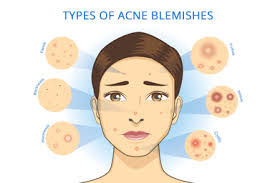 Ayurveda For Acne