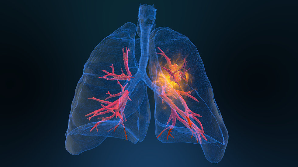 lung-cancer-image.jpeg