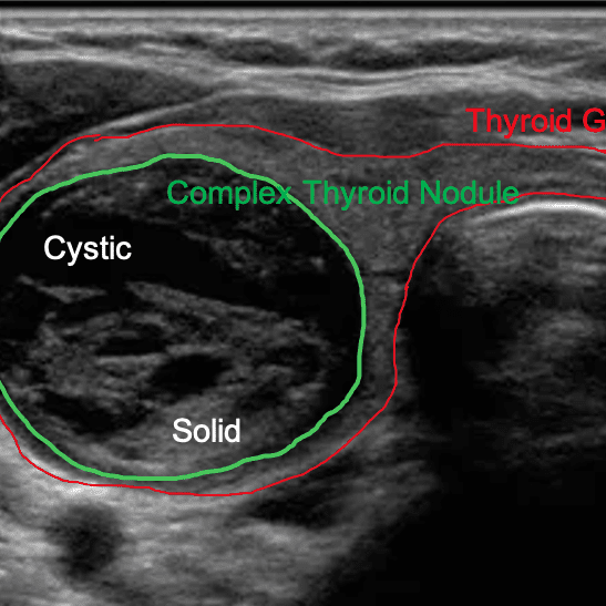 complex-thyroid.png