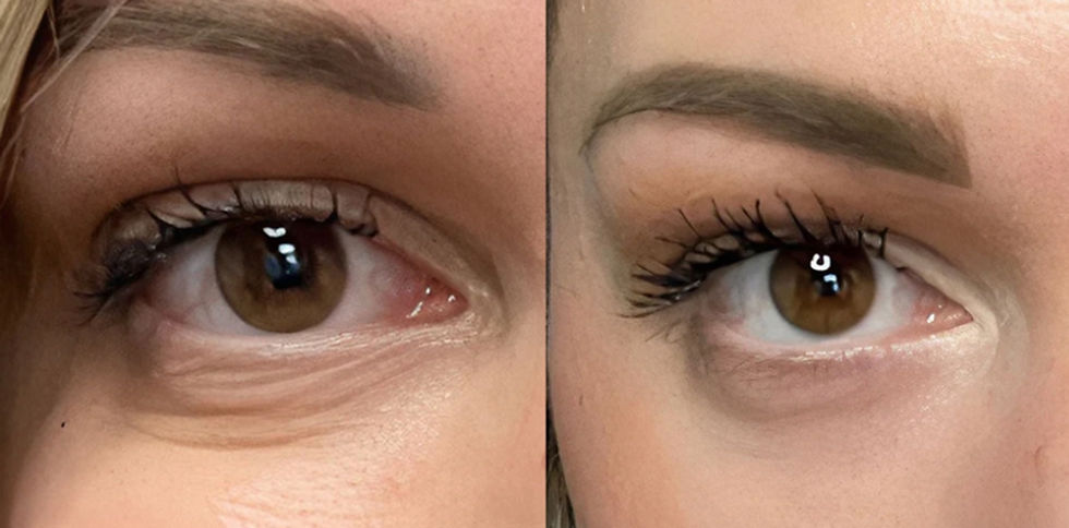 Eye Treatment Photo Difference.