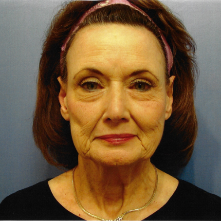 Before and After | Face Lift – 001