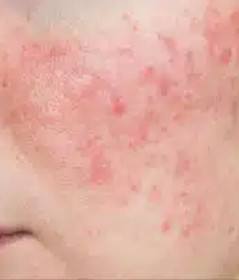 Lupus-treatment-Northern-Kentucky-Cincinnati-300x200.jpeg