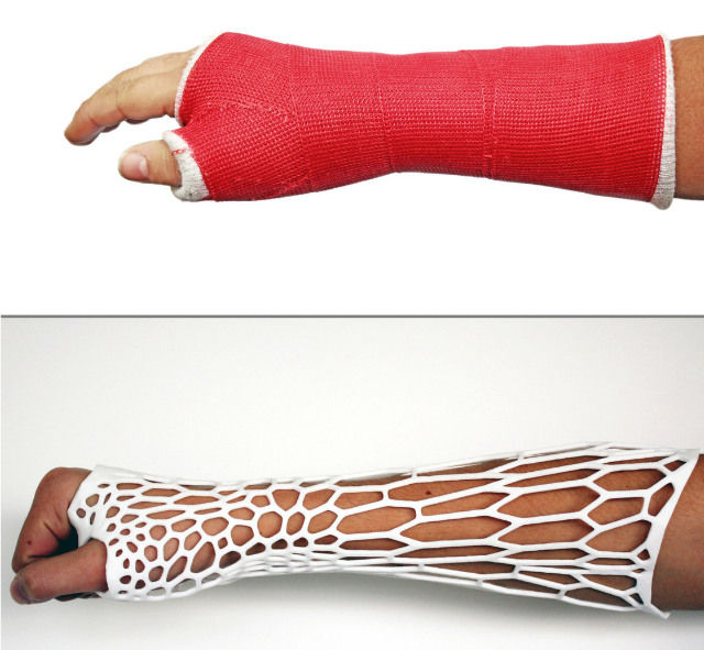 3D Printed Cast For Broken Bones