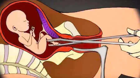 Giornata internazionale dell'aborto sicuro: 6.118.389 gli italiani uccisi tra '78 e il '22 dalla legge 194