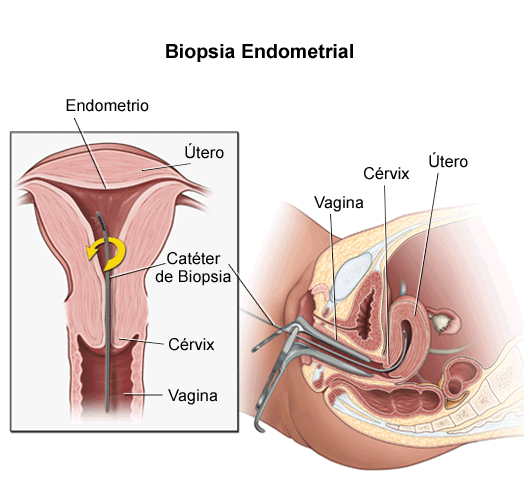 biopsia endometrio.gif