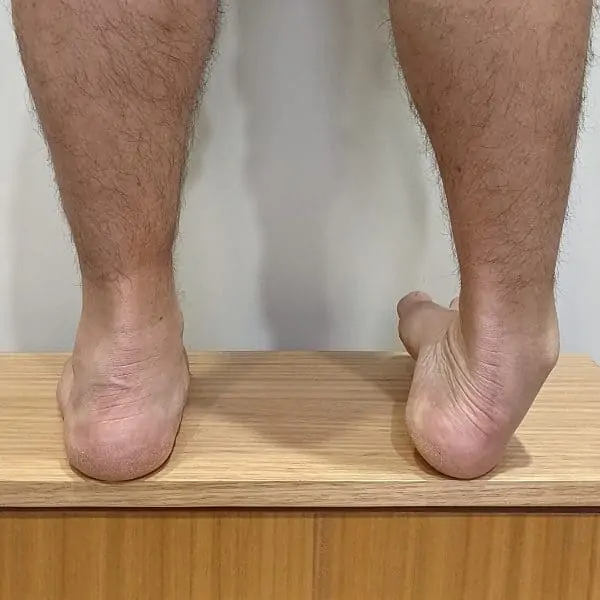How Can I Reduce Risk of Getting Sprained Ankle. Sprained Ankle Symptoms and Treatments at Associated Foot Care Clinic in Culver City, Dr. J. Leonard Knudson, DPM. tends to patients in UCLA, Brentwood, Beverly Hills, Marina Del Rey, Venice, Santa Monica, Westwood, Bel Air, Marina Del Rey Playa Del Rey Century City and the West Los Angeles 90024, 90025, 90034, 90048, 90049, 90049, area. For Foot Care West LA Foot Doctor Culver City PODIATRIST, PODIATRIC SURGEON 90230 90232 Schedule Foot Appointment call: 310-876-1579