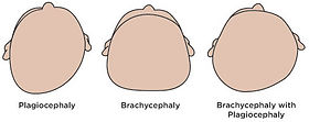 Plagiocephaly | علامات تسطح