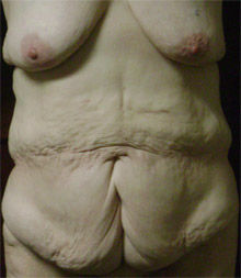 Belt Lipectomy, T-Mastopexy with Breast Implants breast_lift_tummy_tuck_22-1_before.jpg