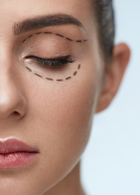 blefaroplastia.jpg