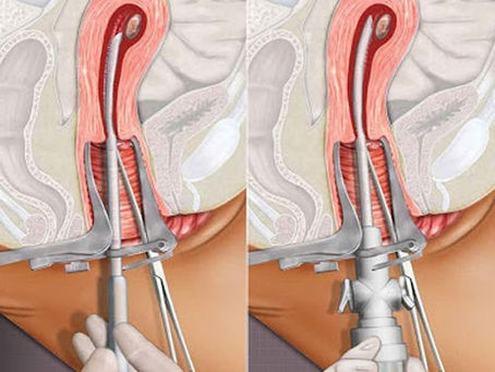 Tìm hiểu về phương pháp phá thai không đau và mức độ an toàn