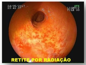 Proctopatia por radiação (retite actínica) – A doença causada pela radioterapia OU a doença do pacie