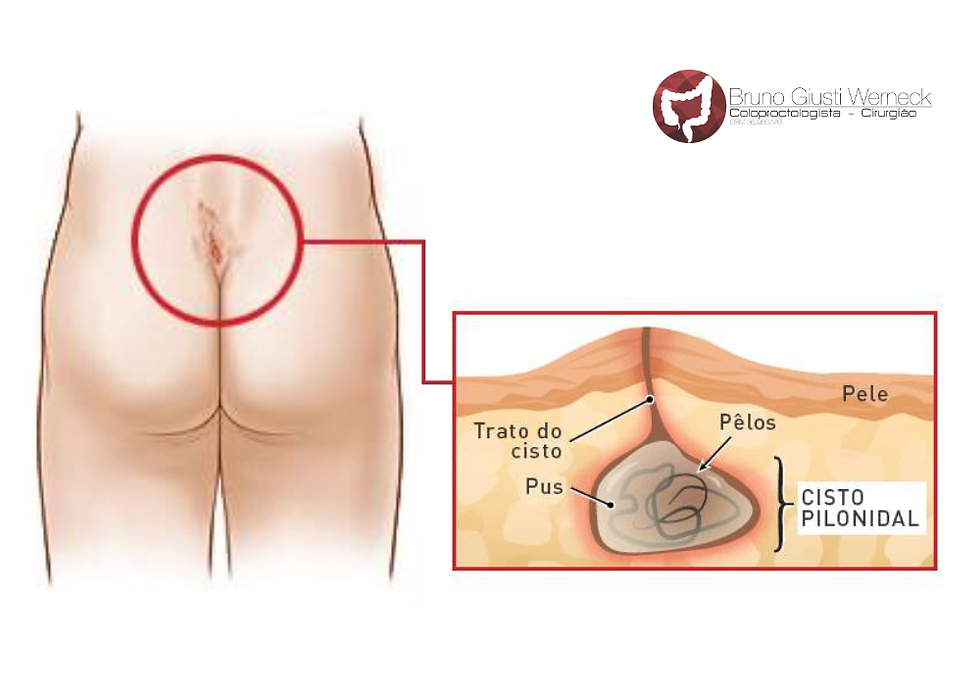 O cisto pilonidal consiste na penetração e/ou presença de pelos abaixo do nível da pele
