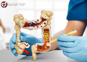 Existe relação entre câncer de intestino e Doenças Inflamatórias Intestinais?