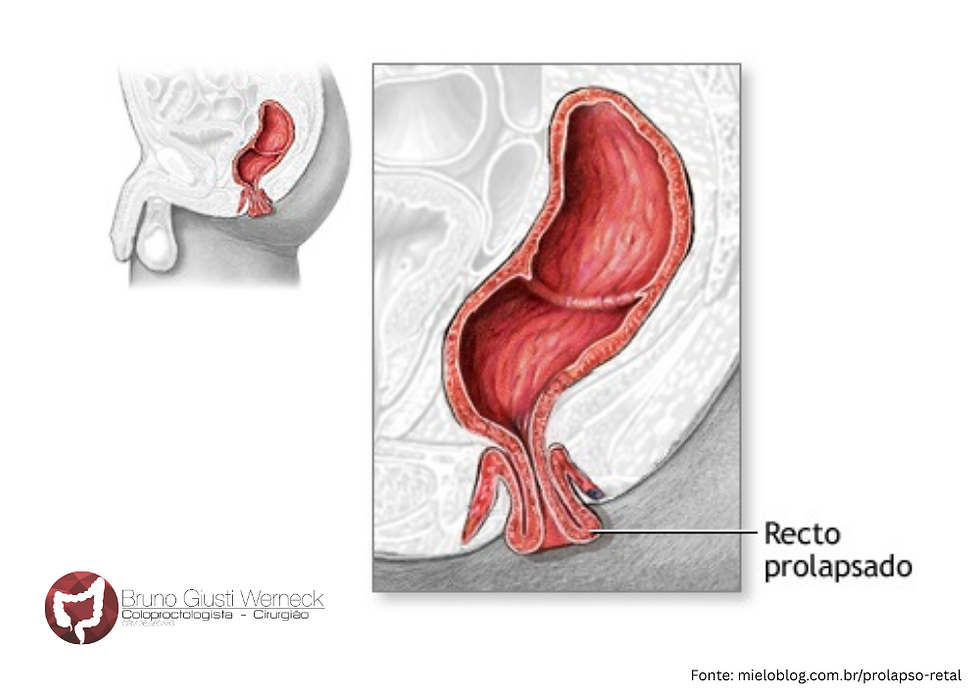 A exteriorização pelo ânus é a principal manifestação do prolapso retal