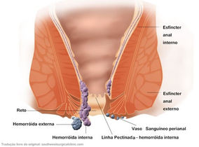 Doença Hemorroidaria (hemorroidas)