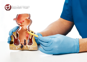 É melhor operar hemorroida de forma preventiva?