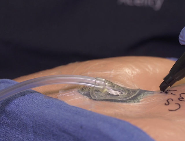 Negative Pressure Wound Therapy | Wound & Stoma Clinic