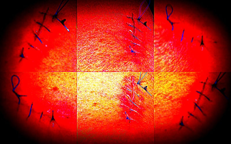 Buring fire all stitched up