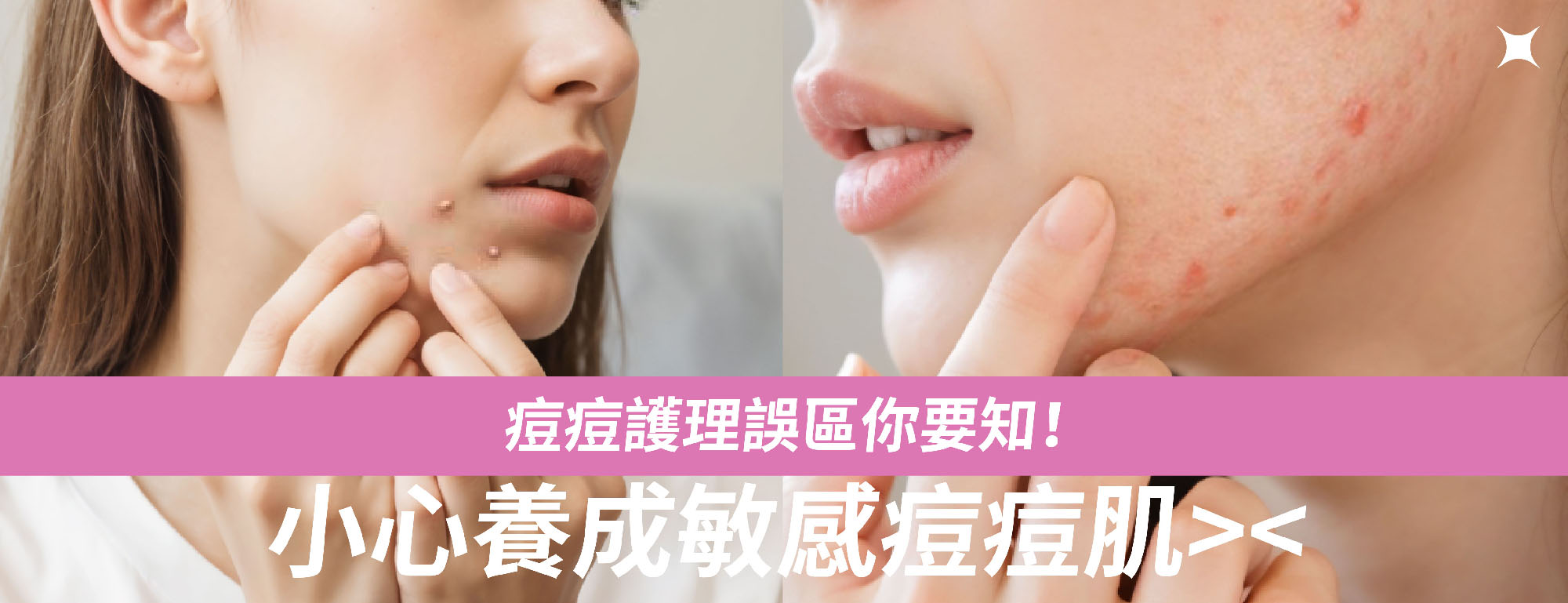 痘痘護理