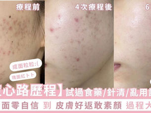 【抗痘心路歷程】由爛面零自信到皮膚靚返敢素顏過程大公開!