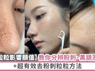 【臉上粒粒影響顏值】教你分辨粉刺、黑頭及 暗粒！+超有效去粉刺粒粒方法