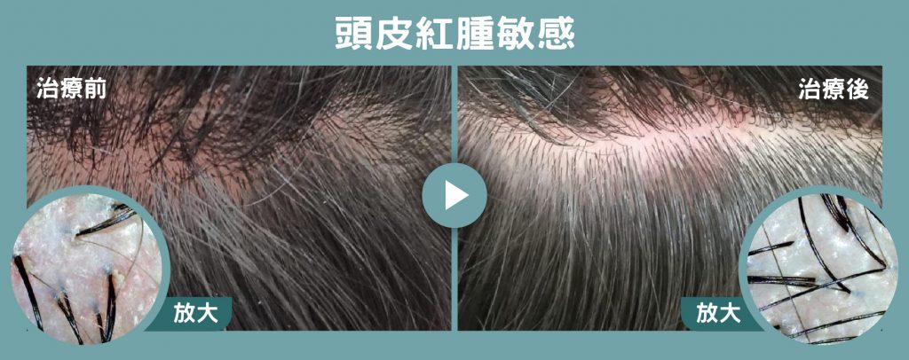 高壓氣頻頭皮養護 HairHealth