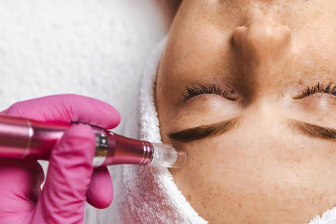 What Is Dermapen Treatment for Healthier Looking Skin?