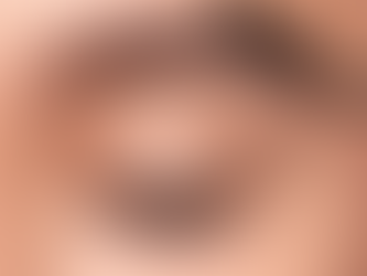 Does Eyebrow Hair Transplant Look Natural?