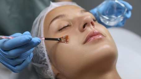 What Are the Key Benefits of PCA Peel Treatment?